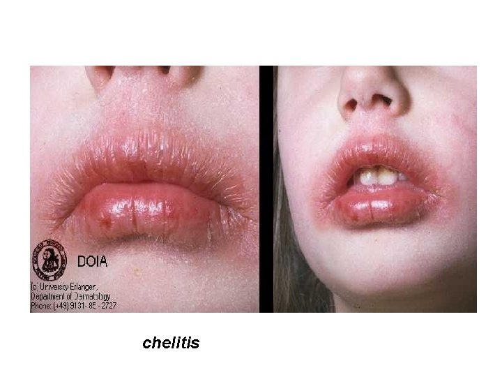 chelitis 