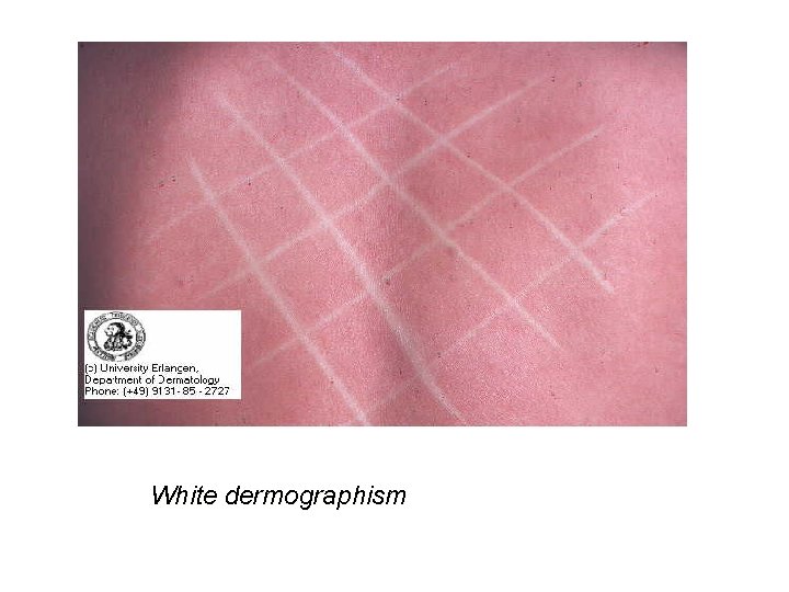 White dermographism 