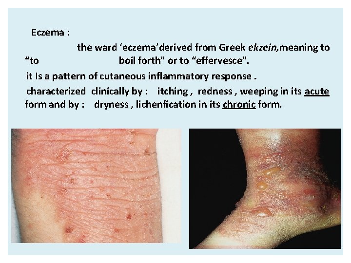 Eczema : the ward ‘eczema’derived from Greek ekzein, meaning to “to boil forth” or