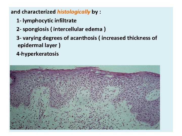 and characterized histologically by : 1 - lymphocytic infiltrate 2 - spongiosis ( intercellular