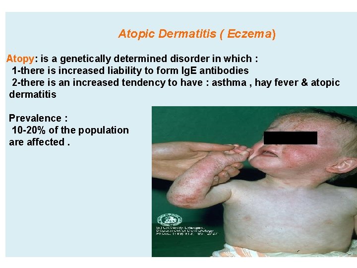 Atopic Dermatitis ( Eczema ) Atopy: is a genetically determined disorder in which :