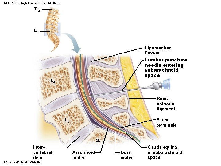 Figure 12. 28 Diagram of a lumbar puncture. T 12 L 5 Ligamentum flavum