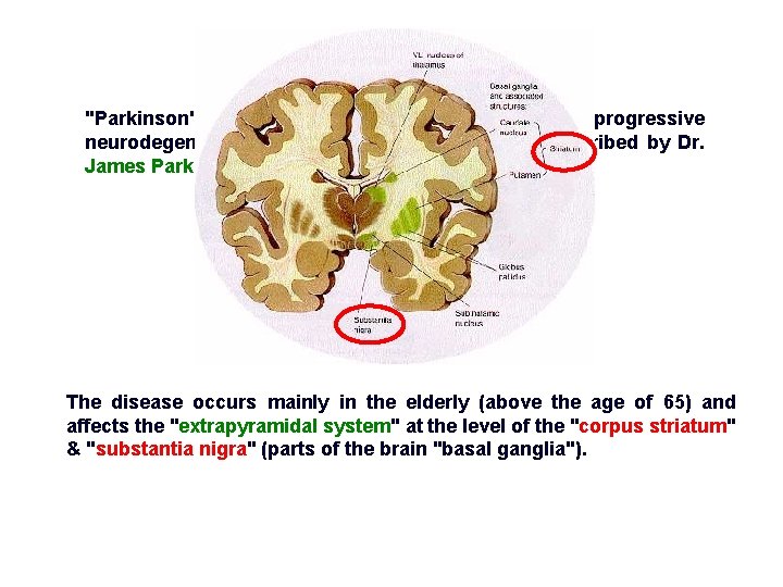 "Parkinson's disease" (Parkinsonism, PD) is a progressive neurodegenerative brain disorder that was first described