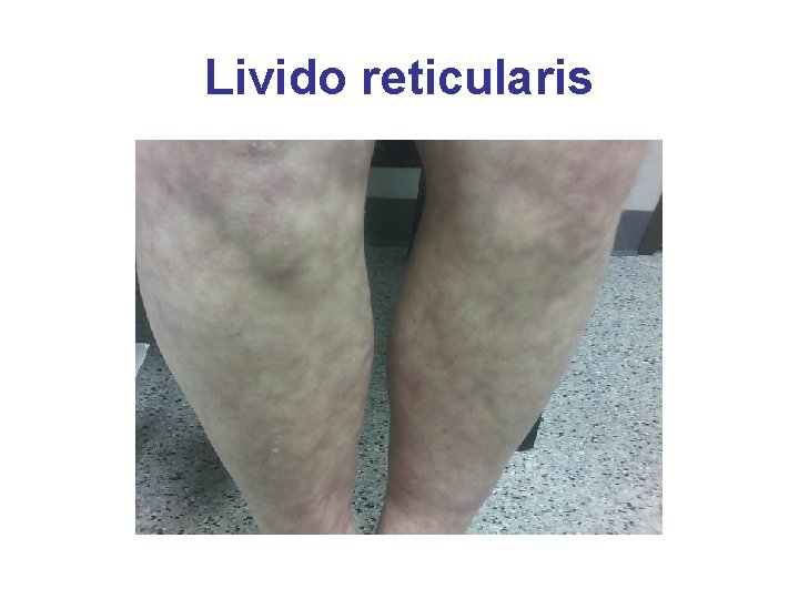 Livido reticularis 