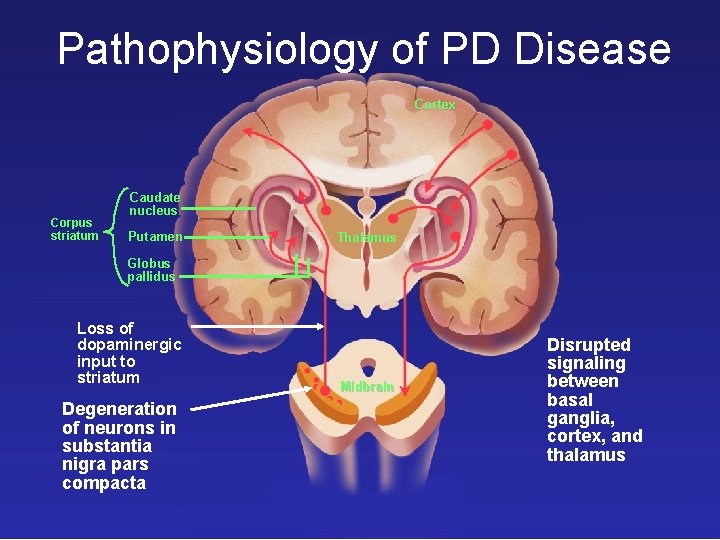 Pathophysiology of PD Disease Cortex Corpus striatum Caudate nucleus Putamen Thalamus Globus pallidus Loss