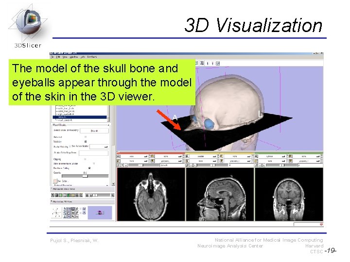 3 D Visualization The model of the skull bone and eyeballs appear through the 3 D Visualization The model of the skull bone and eyeballs appear through the