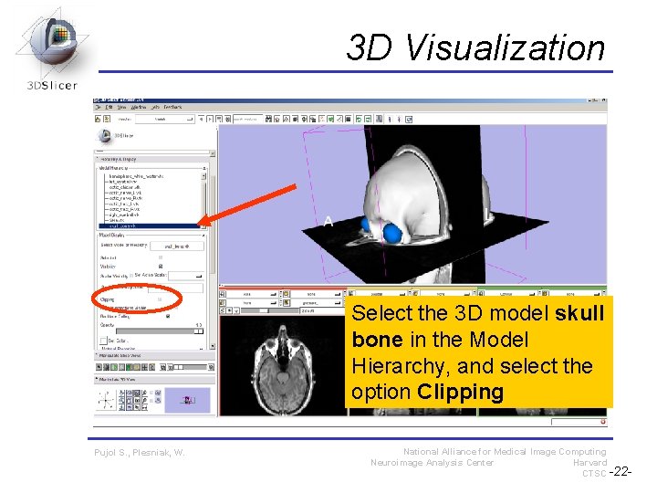 3 D Visualization Select the 3 D model skull bone in the Model Hierarchy, 3 D Visualization Select the 3 D model skull bone in the Model Hierarchy,