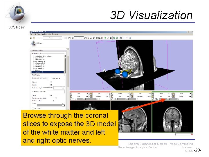 3 D Visualization Browse through the coronal slices to expose the 3 D model 3 D Visualization Browse through the coronal slices to expose the 3 D model