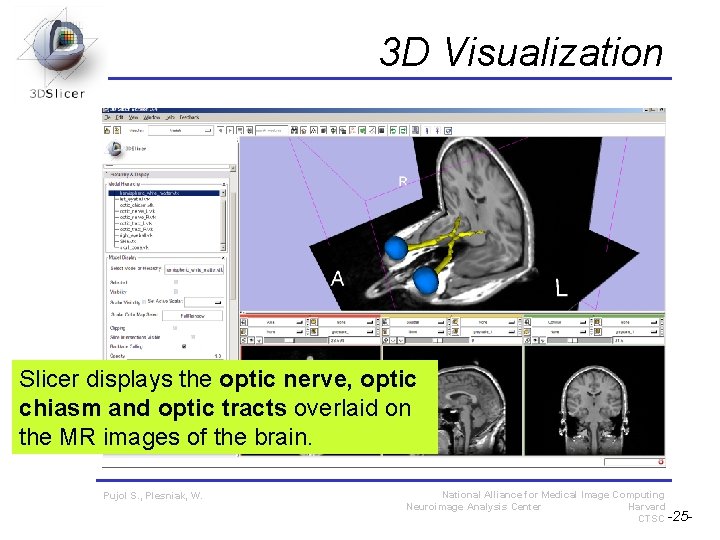 3 D Visualization Slicer displays the optic nerve, optic chiasm and optic tracts overlaid 3 D Visualization Slicer displays the optic nerve, optic chiasm and optic tracts overlaid