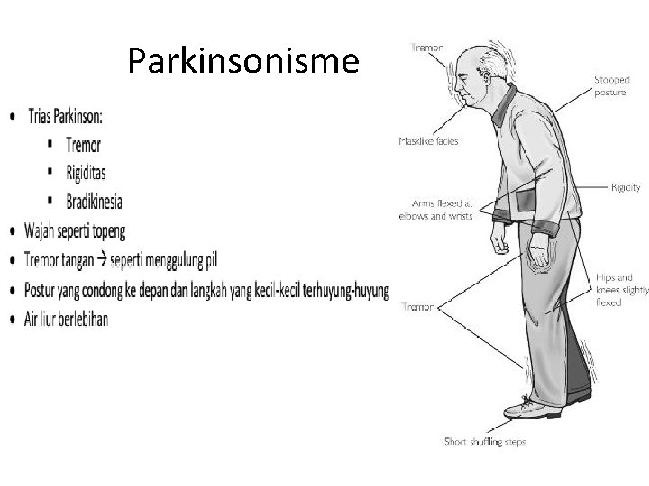 Parkinsonisme Parkinsonisme