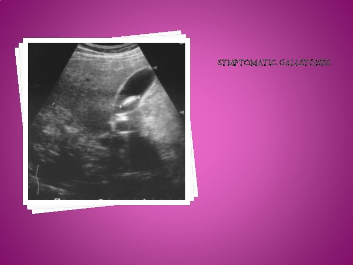 SYMPTOMATIC GALLSTONES SYMPTOMATIC GALLSTONES