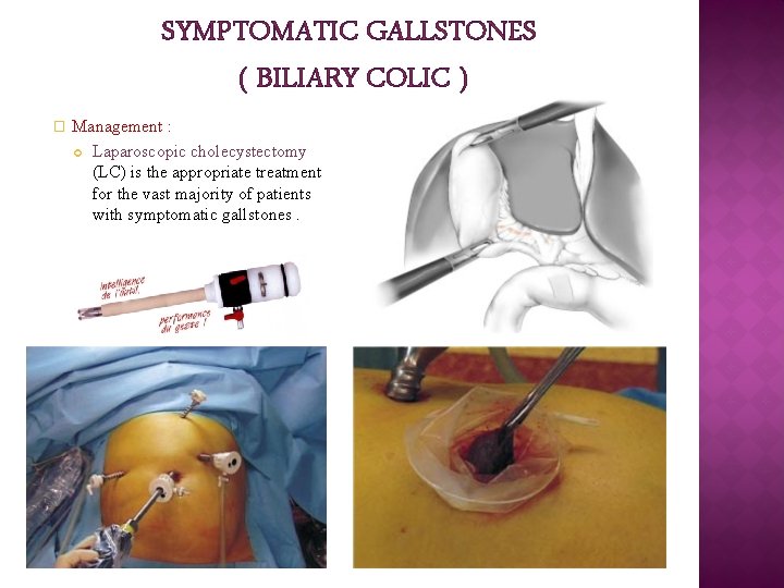 SYMPTOMATIC GALLSTONES ( BILIARY COLIC ) � Management : Laparoscopic cholecystectomy (LC) is the SYMPTOMATIC GALLSTONES ( BILIARY COLIC ) � Management : Laparoscopic cholecystectomy (LC) is the