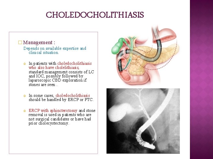 CHOLEDOCHOLITHIASIS � Management : Depends on available expertise and clinical situation. In patients with CHOLEDOCHOLITHIASIS � Management : Depends on available expertise and clinical situation. In patients with