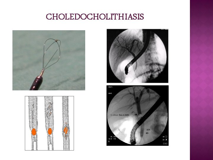 CHOLEDOCHOLITHIASIS CHOLEDOCHOLITHIASIS