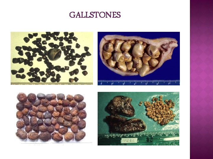 GALLSTONES GALLSTONES