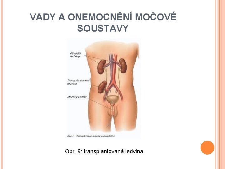 VADY A ONEMOCNĚNÍ MOČOVÉ SOUSTAVY Obr. 9: transplantovaná ledvina 