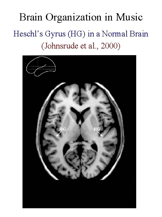 Brain Organization in Music Heschl’s Gyrus (HG) in a Normal Brain (Johnsrude et al.