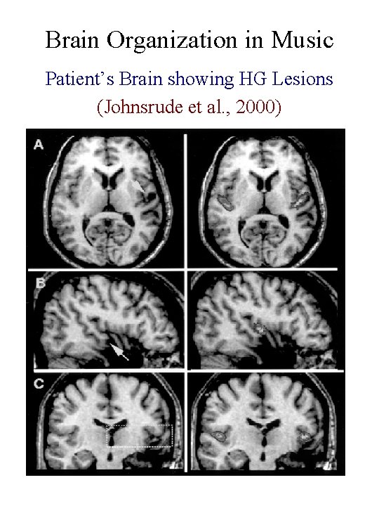 Brain Organization in Music Patient’s Brain showing HG Lesions (Johnsrude et al. , 2000)
