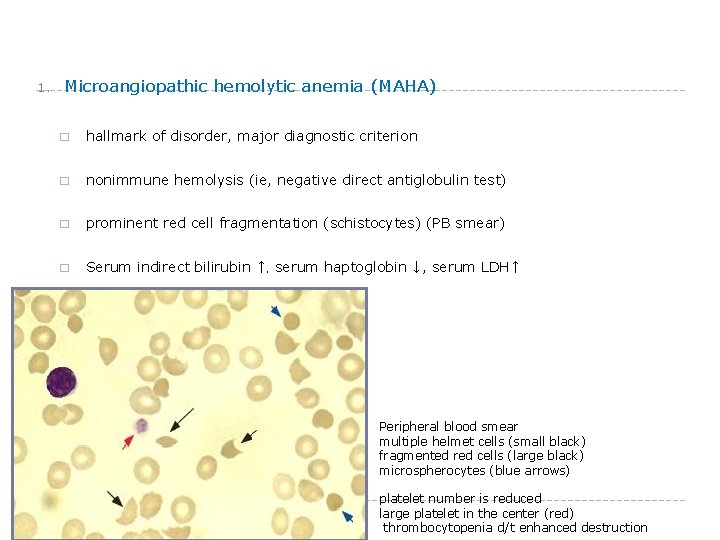 1. Microangiopathic hemolytic anemia (MAHA) � hallmark of disorder, major diagnostic criterion � nonimmune