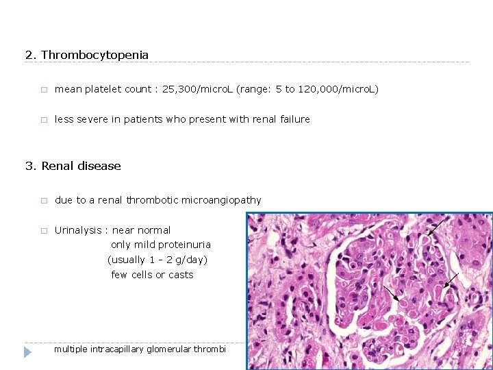 2. Thrombocytopenia � mean platelet count : 25, 300/micro. L (range: 5 to 120,