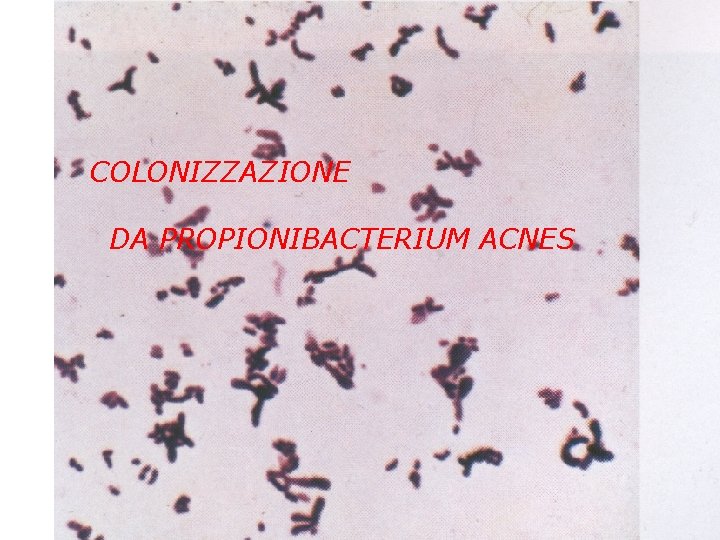  COLONIZZAZIONE DA PROPIONIBACTERIUM ACNES 