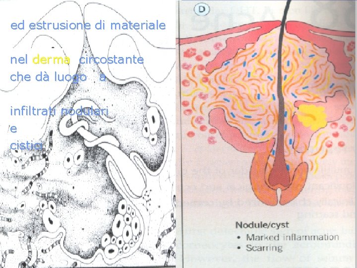  ed estrusione di materiale nel derma circostante che dà luogo a infiltrati nodulari