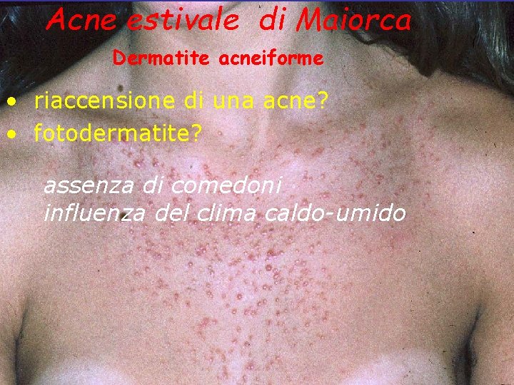 Acne estivale di Maiorca Dermatite acneiforme • riaccensione di una acne? • fotodermatite? assenza