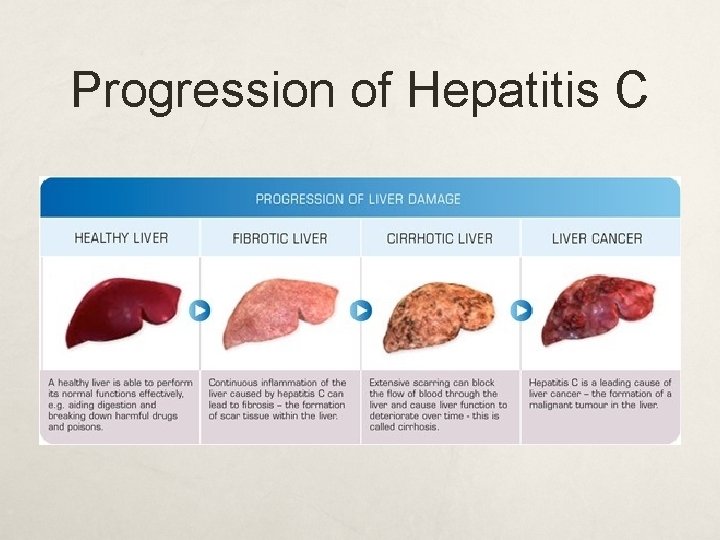 Progression of Hepatitis C 