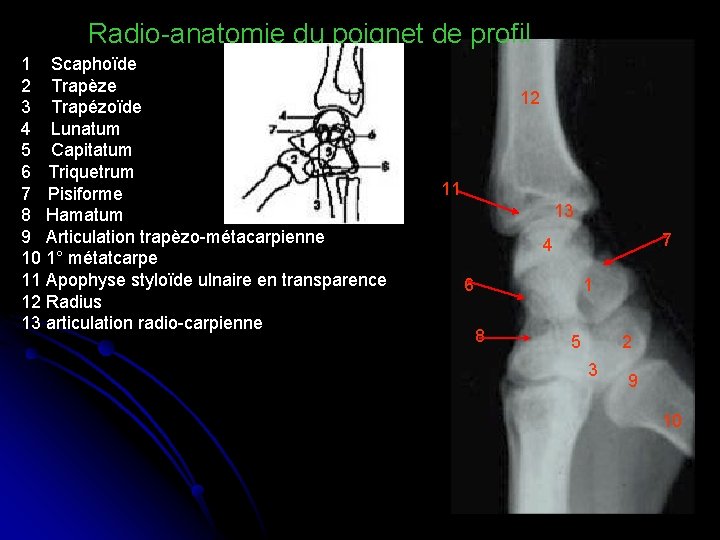 Radio-anatomie du poignet de profil 1 Scaphoïde 2 Trapèze 3 Trapézoïde 4 Lunatum 5