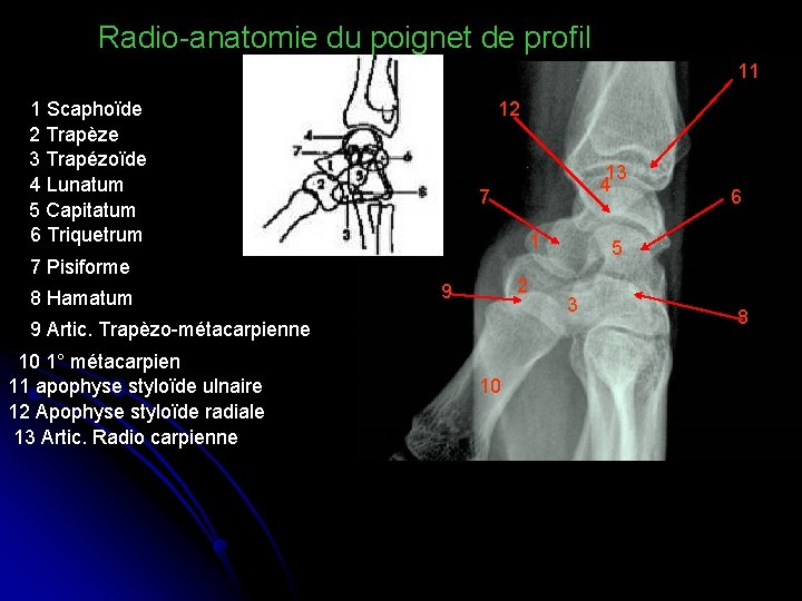 Radio-anatomie du poignet de profil 11 1 Scaphoïde 2 Trapèze 3 Trapézoïde 4 Lunatum