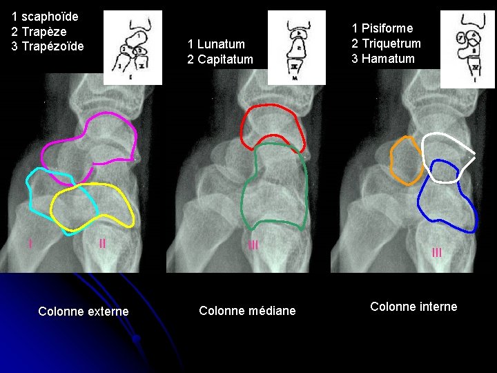 1 scaphoïde 2 Trapèze 3 Trapézoïde I 1 Lunatum 2 Capitatum II Colonne externe