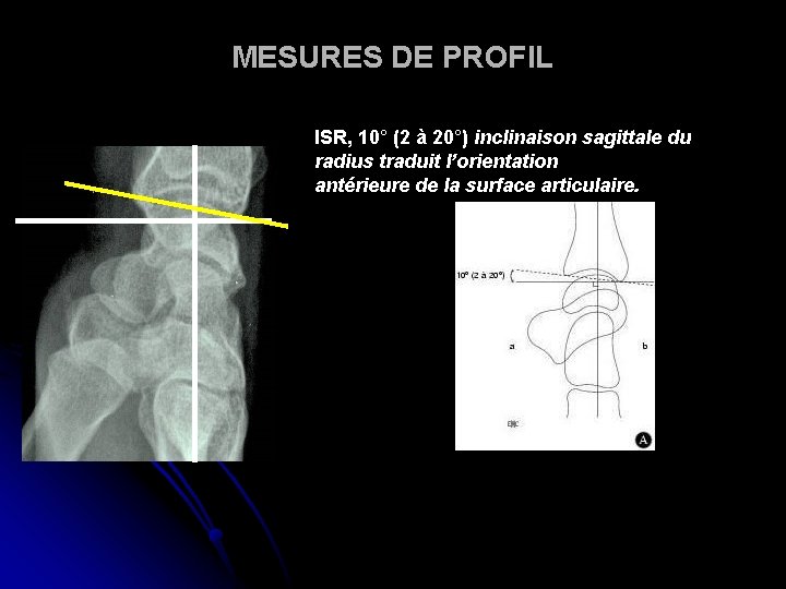 MESURES DE PROFIL ISR, 10° (2 à 20°) inclinaison sagittale du radius traduit l’orientation