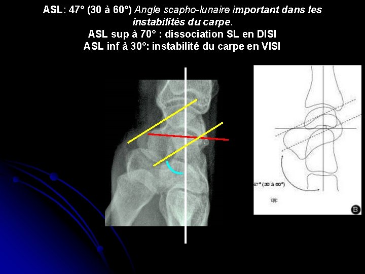 ASL: 47° (30 à 60°) Angle scapho-lunaire important dans les instabilités du carpe. ASL