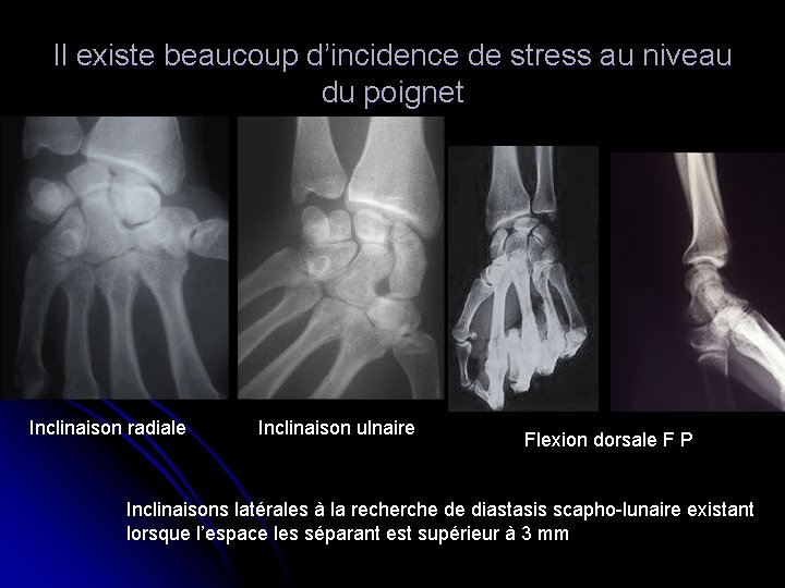 Il existe beaucoup d’incidence de stress au niveau du poignet Inclinaison radiale Inclinaison ulnaire