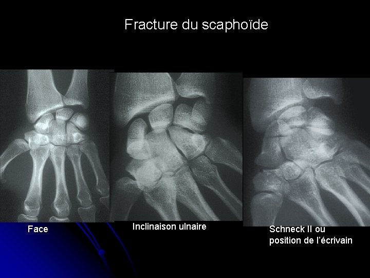 Fracture du scaphoïde Face Inclinaison ulnaire Schneck II ou position de l’écrivain 