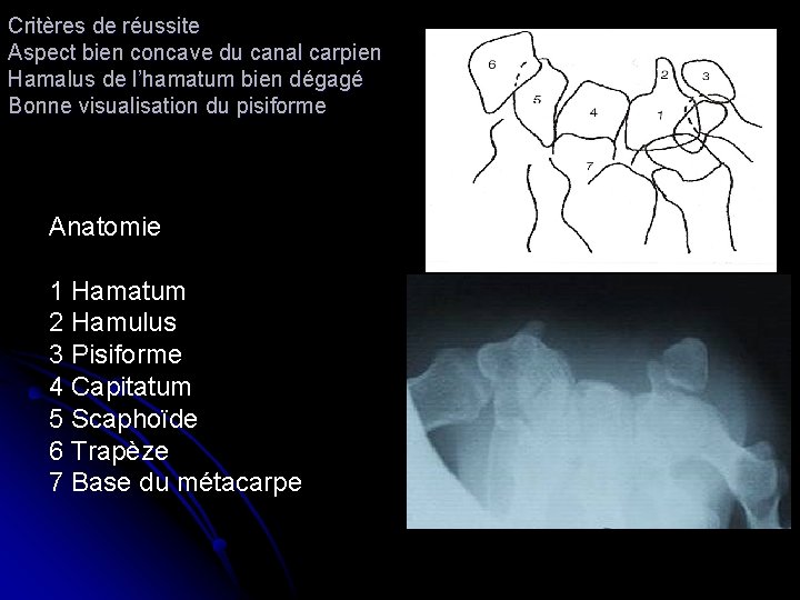 Critères de réussite Aspect bien concave du canal carpien Hamalus de l’hamatum bien dégagé