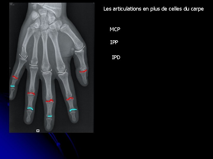 Les articulations en plus de celles du carpe MCP IPD 