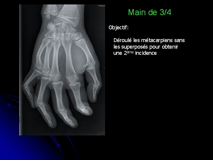 Main de 3/4 Objectif: Déroulé les métacarpiens sans les superposés pour obtenir une 2ème