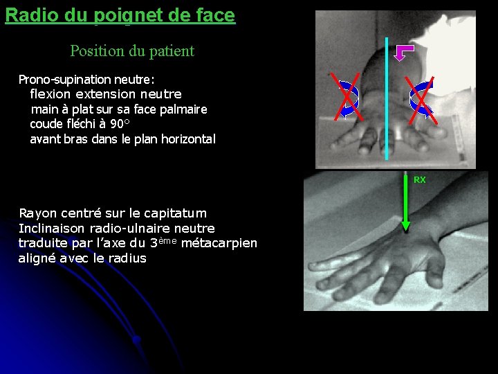 Radio du poignet de face Position du patient Prono-supination neutre: flexion extension neutre main