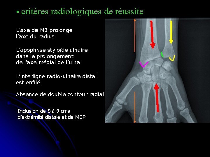 § critères radiologiques de réussite L’axe de M 3 prolonge l’axe du radius L’apophyse