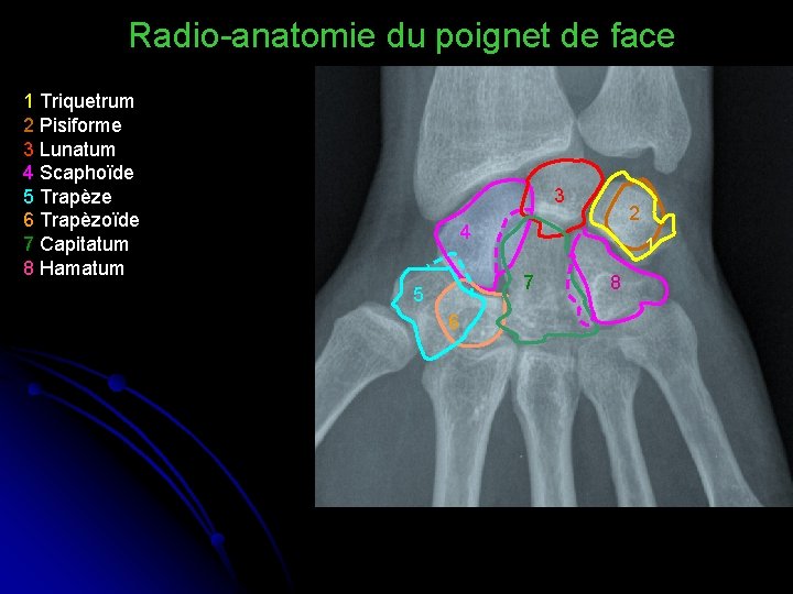 Radio-anatomie du poignet de face 1 Triquetrum 2 Pisiforme 3 Lunatum 4 Scaphoïde 5