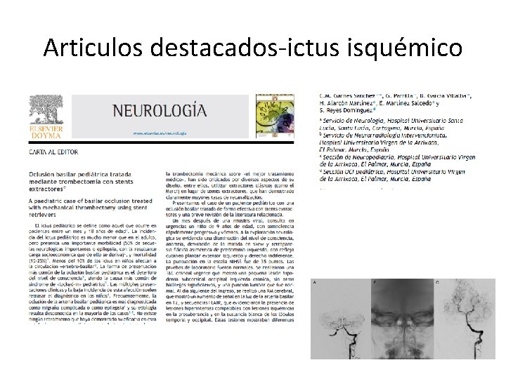 Articulos destacados-ictus isquémico Articulos destacados-ictus isquémico
