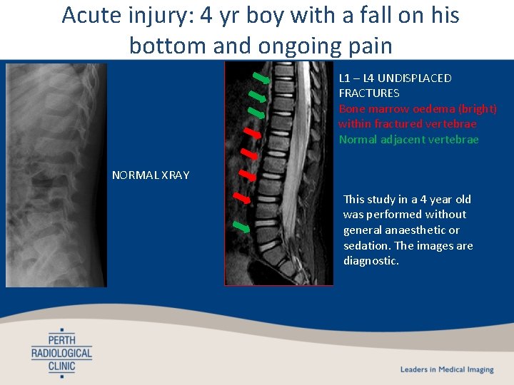 Acute injury: 4 yr boy with a fall on his bottom and ongoing pain