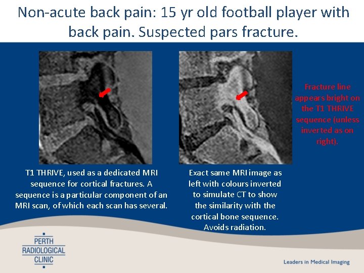 Non-acute back pain: 15 yr old football player with back pain. Suspected pars fracture. Non-acute back pain: 15 yr old football player with back pain. Suspected pars fracture.