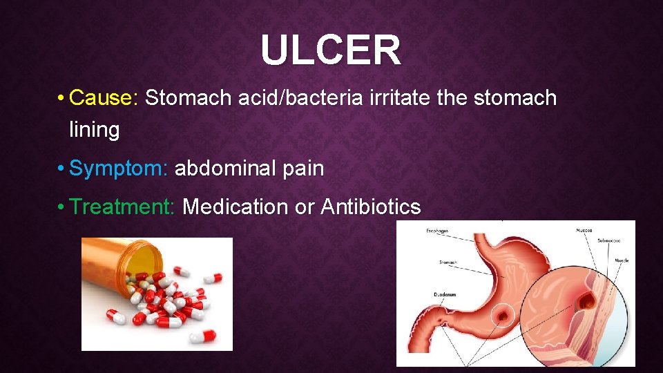 ULCER • Cause: Stomach acid/bacteria irritate the stomach lining • Symptom: abdominal pain •