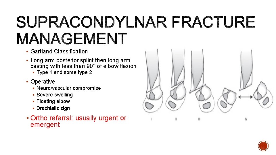 § Gartland Classification § Long arm posterior splint then long arm casting with less