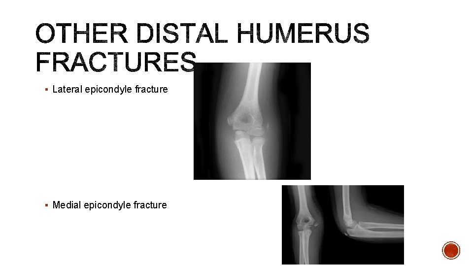 § Lateral epicondyle fracture § Medial epicondyle fracture 