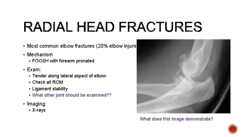 § Most common elbow fractures (20% elbow injuries) § Mechanism § FOOSH with forearm