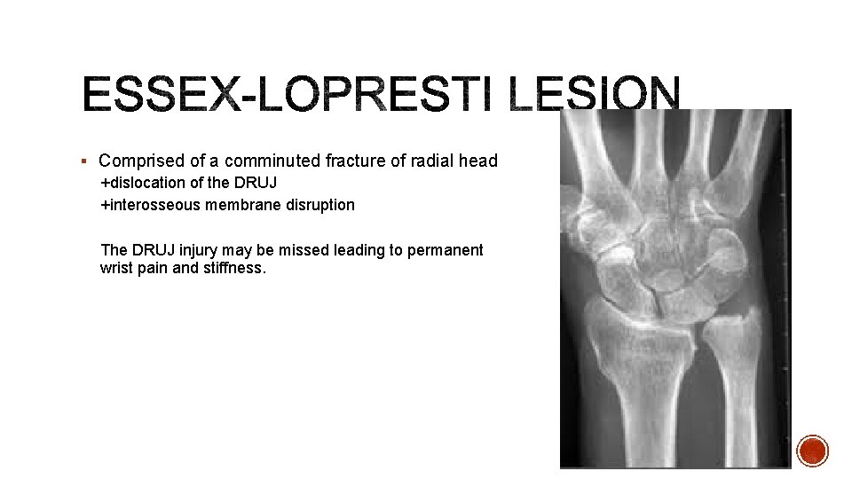 § Comprised of a comminuted fracture of radial head +dislocation of the DRUJ +interosseous