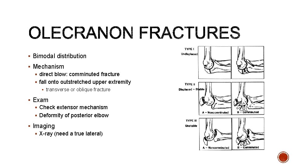 § Bimodal distribution § Mechanism § direct blow: comminuted fracture § fall onto outstretched